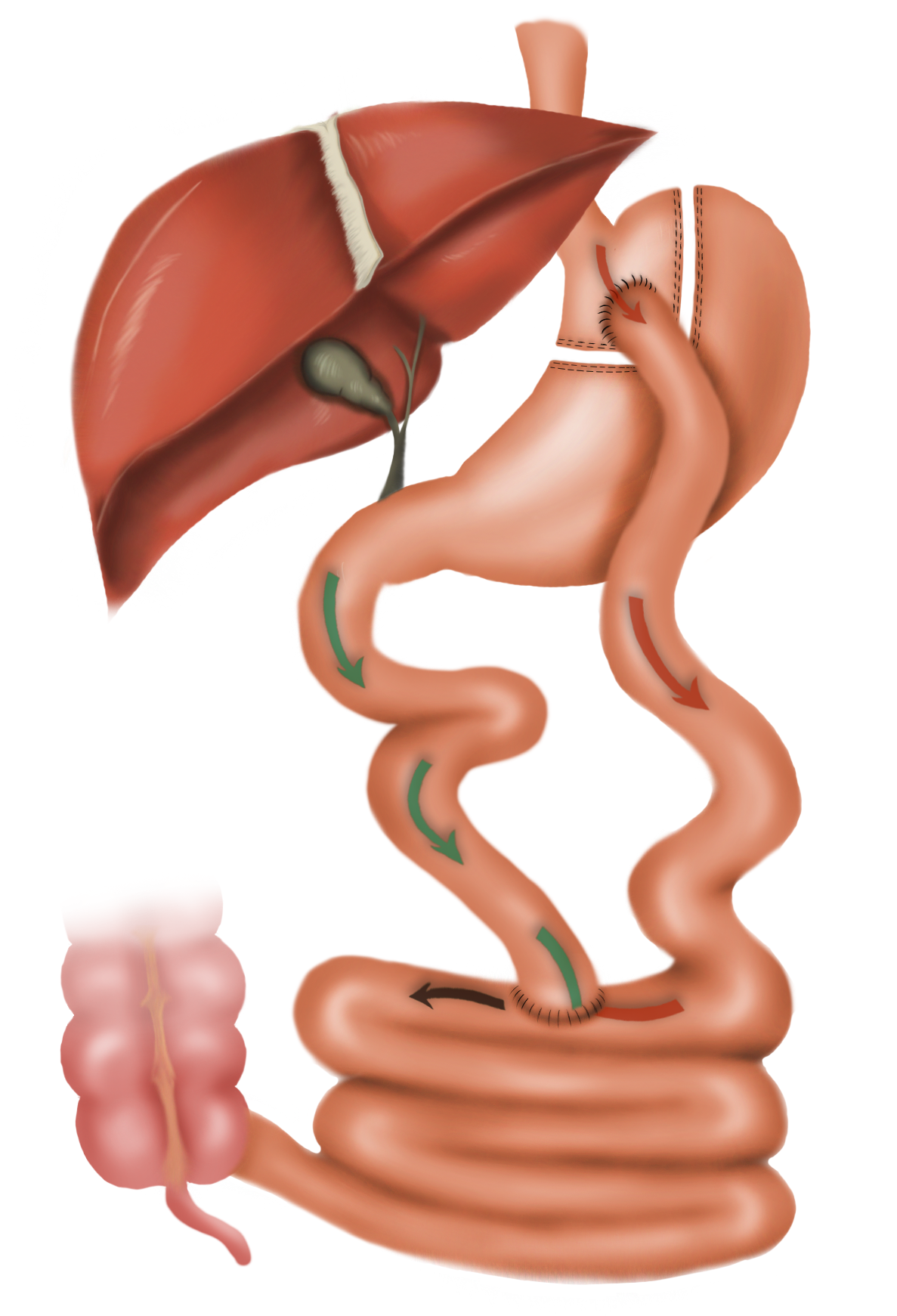 Roux-en Y gastric bypass surgery diagram